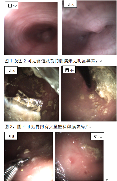 內(nèi)窺鏡在貓的慢性嘔吐病例中的應用舉例